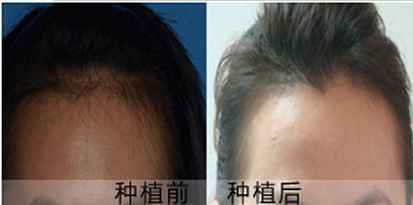武汉碧莲盛头发种植 “种”出来的健康好秀发