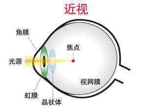 戴眼镜会让眼睛近视度数加深吗？