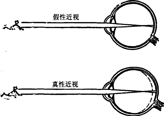 戴眼镜会让眼睛近视度数加深吗？