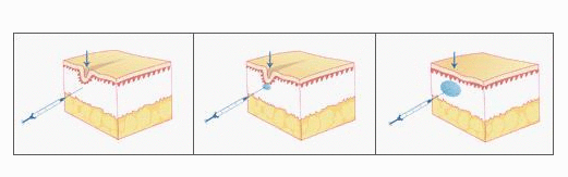 北京彤美医疗医院好吗 眉间纹怎么去掉