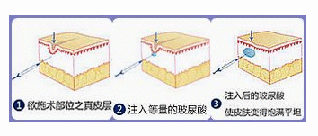 玻尿酸注射除皱 只要保养好，老公在高考