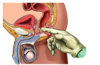 直肠指检