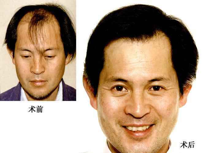 北京中德毛发移植整形医院头发种植 告别秃顶恢复自信