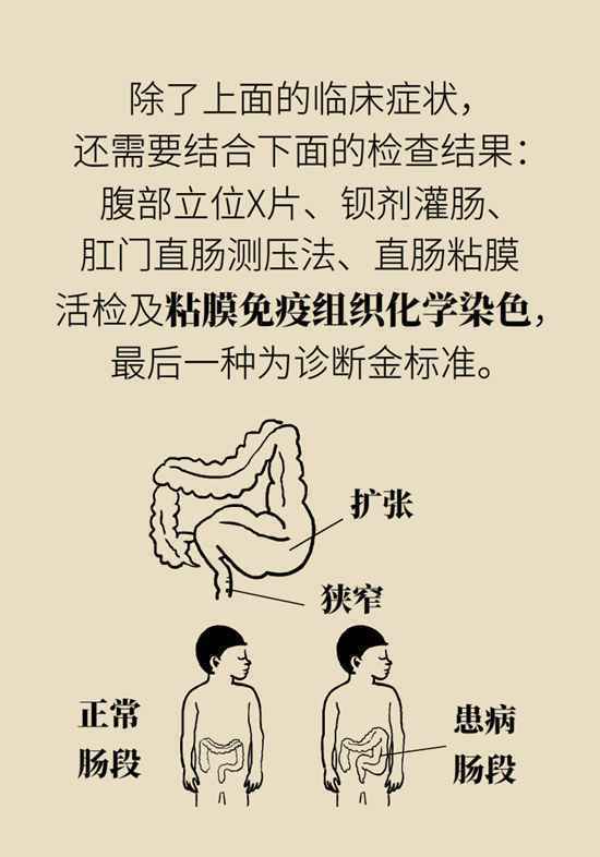 宝宝用开塞露还便秘，警惕先天性巨结肠