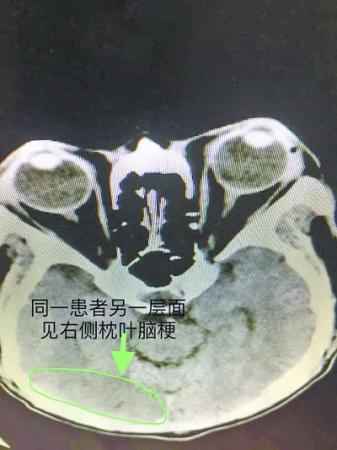 老人头晕眼花眼前模糊竟是“后脑梗死”