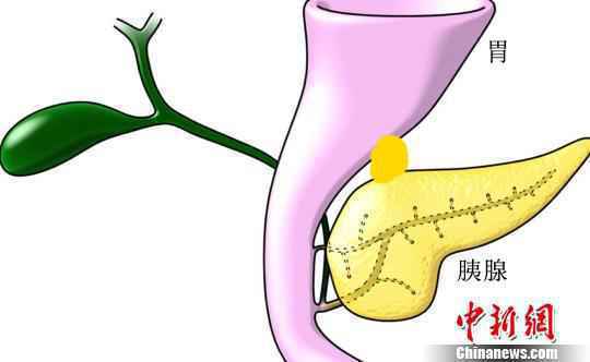 胰腺“长”在胃上 罹患罕见病婴儿在上海获救