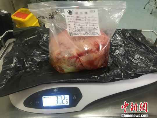 湖南女子左腿肿胀发紫 6斤重子宫肌瘤是祸根