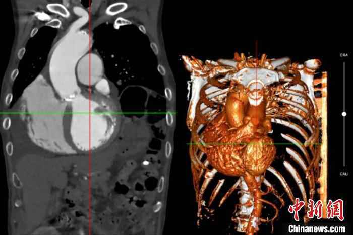 老人天生“翻转”心脏 多病垂危 专家一站式手术