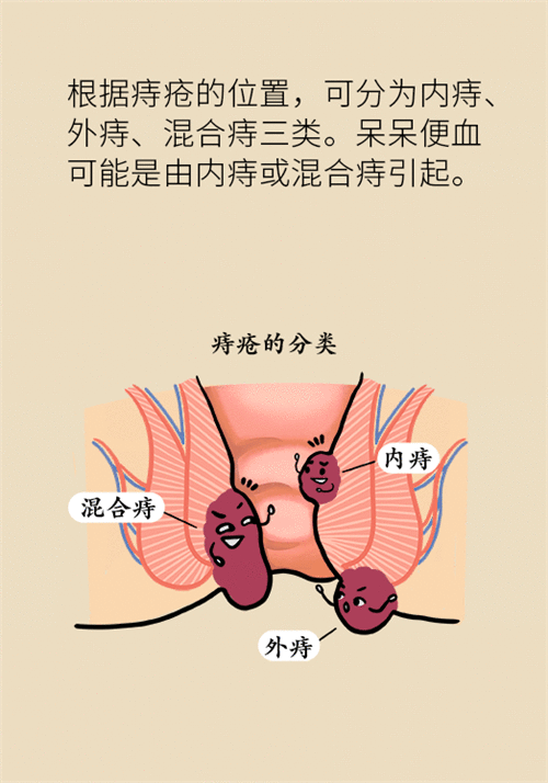 肛门肿胀还有血？小心痔疮找上门