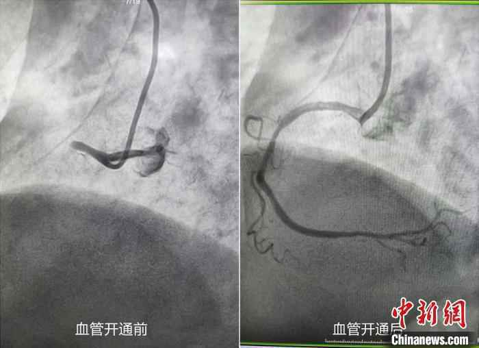 浙江一老妇遭遇“电风暴” 医生14次电除颤挽回