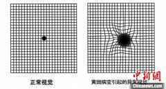 专家呼吁重视眼底病早诊早治 优化转诊制度