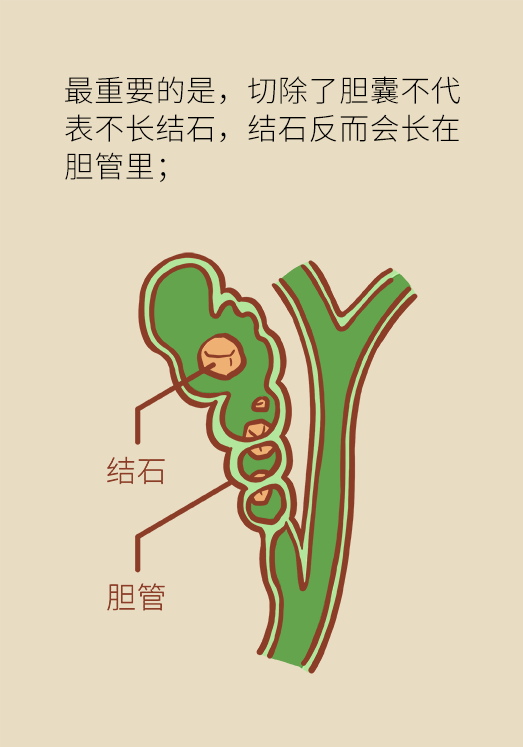 得了胆结石不能轻易开刀 胆囊有功能者建议微创