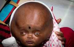 印度3月大男婴患脑水肿 脑袋为正常三倍大