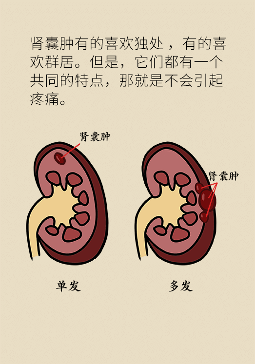 患有单纯性肾囊肿不要慌 要不要切看情况