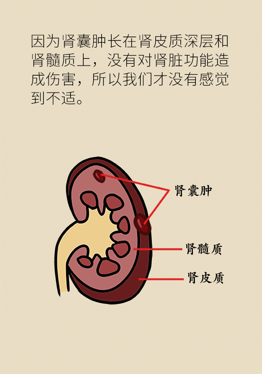 患有单纯性肾囊肿不要慌 要不要切看情况