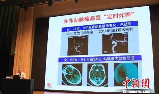 中国科学院院士、国家神经系统疾病临床医学研究中心主任赵继宗进行科普讲座。北京天坛医院供图