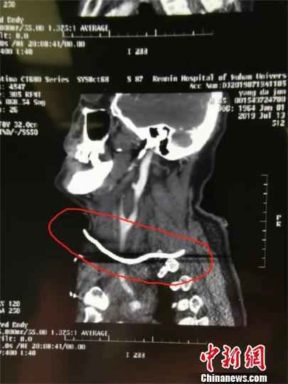 金属环崩断成“钉”，插入患者颈部。院方供图