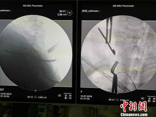 手术拔“钉”。院方供图