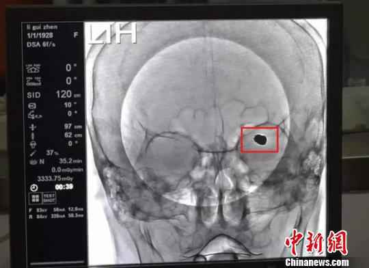 老人术后填充的动脉瘤造影。　院方供图 摄