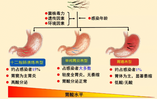 放任幽门螺杆菌不管，会有什么严重后果？